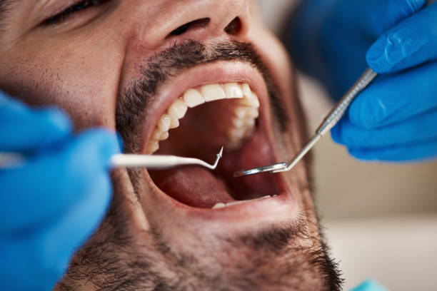 Best Wisdom Tooth Removal  in Eagle Mountain, UT